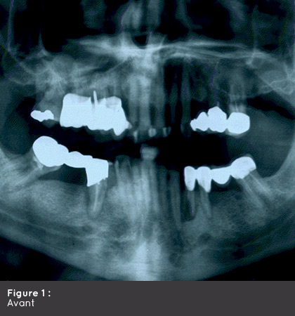 Pisb Parodontologie Et Implantologie Dentaire Saint Brieuc Cabinet Pisb Implantologie Cas Clinique01