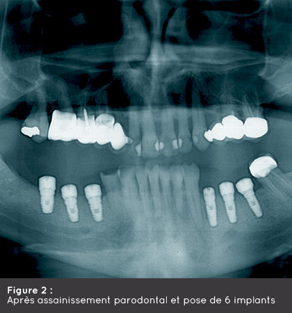 Pisb Parodontologie Et Implantologie Dentaire Saint Brieuc Cabinet Pisb Implantologie Cas Clinique02